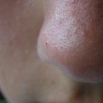 Korekcja nosa – jak się przygotować?
